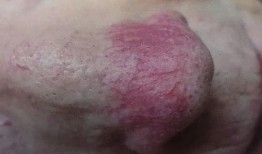 玫瑰痤疮吃哈密瓜,天然食疗的护肤之道